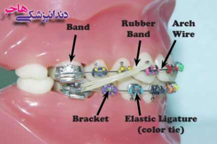براکت دندان از اجزای مختلفی تشکیل شده است